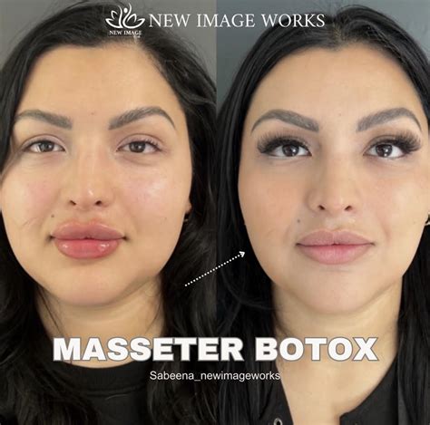 masseter botox las vegas.